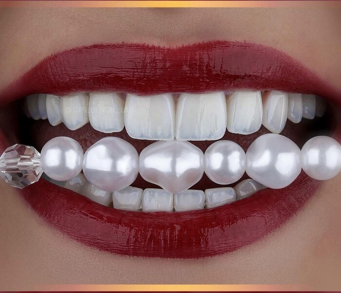 veneer1