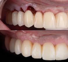 zirconia1